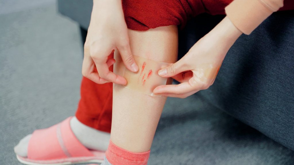 暗瘡傷口用Nexcare™敷貼「濕潤療創」減低疤痕形成機會