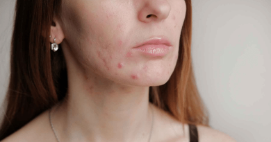 「口罩肌」焗出痘痘、皮膚敏感？植物油洗臉越洗越油？護膚4大注意事項