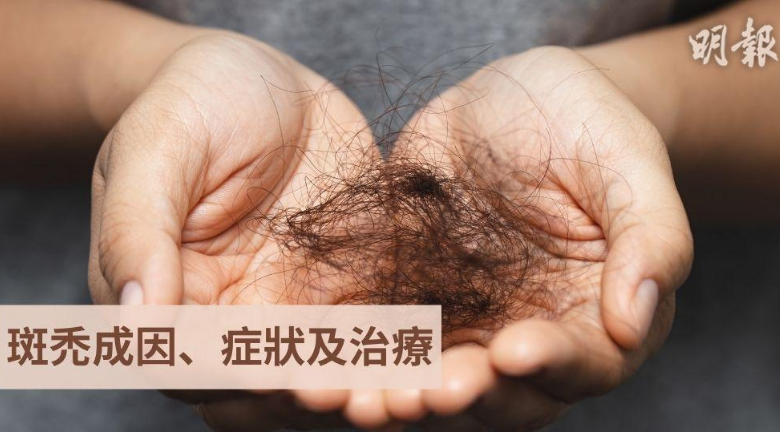 知多啲。斑禿｜壓力大可誘發「鬼剃頭」斑禿 高危發病年齡一般在30歲前 五成患者自行痊癒 預防斑禿有法